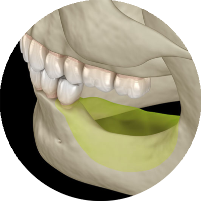 3d model of bone augmentation