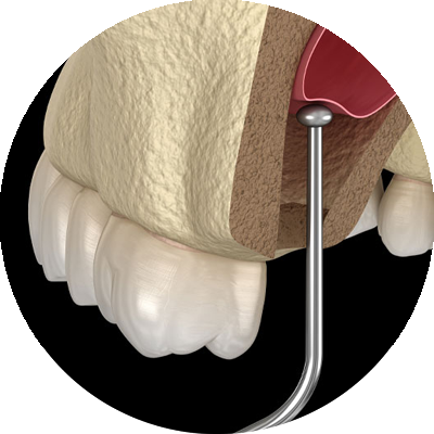 3d model of sinuslift