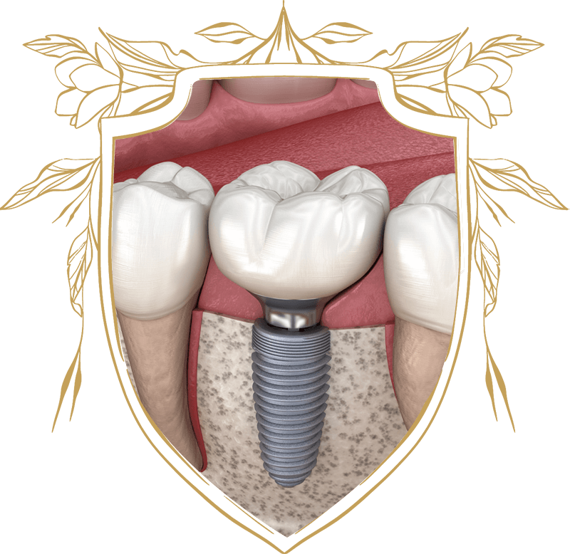 dental implant 3d model