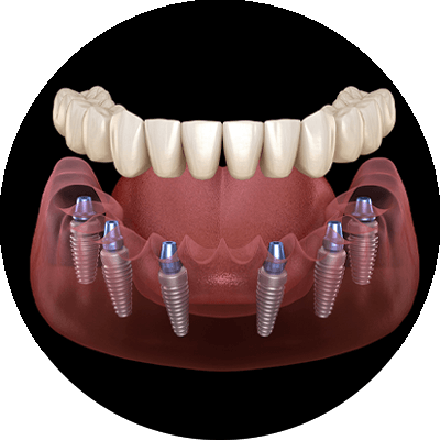 full arch implant 3d model2