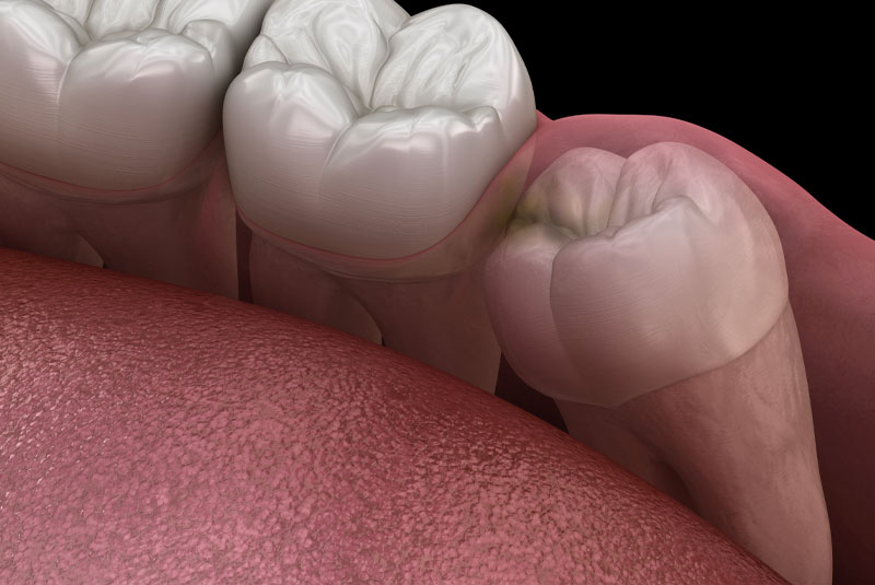 wisdom tooth coming in sideways needing removal