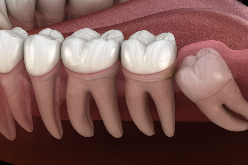 wisdom tooth 3d model 5